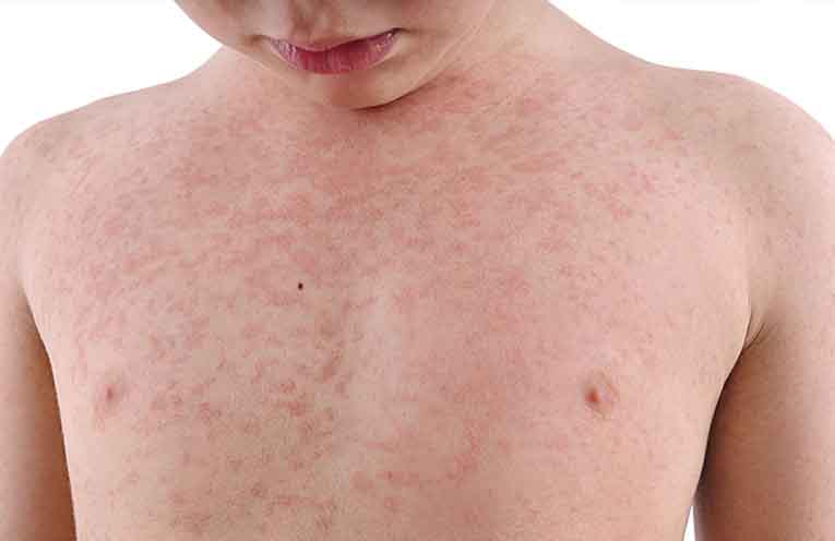 Measles is about – check that your immunisations are up to date